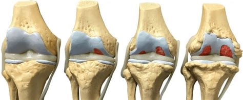 артроза на коляното след раждане